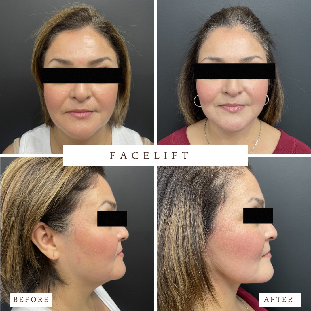 Facelift before and after — actual VedaNu Wellness patient of Dr. James Chao