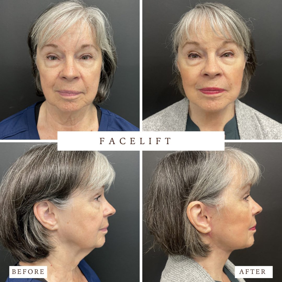 Facelift before and after — actual VedaNu Wellness patient of Dr. James Chao