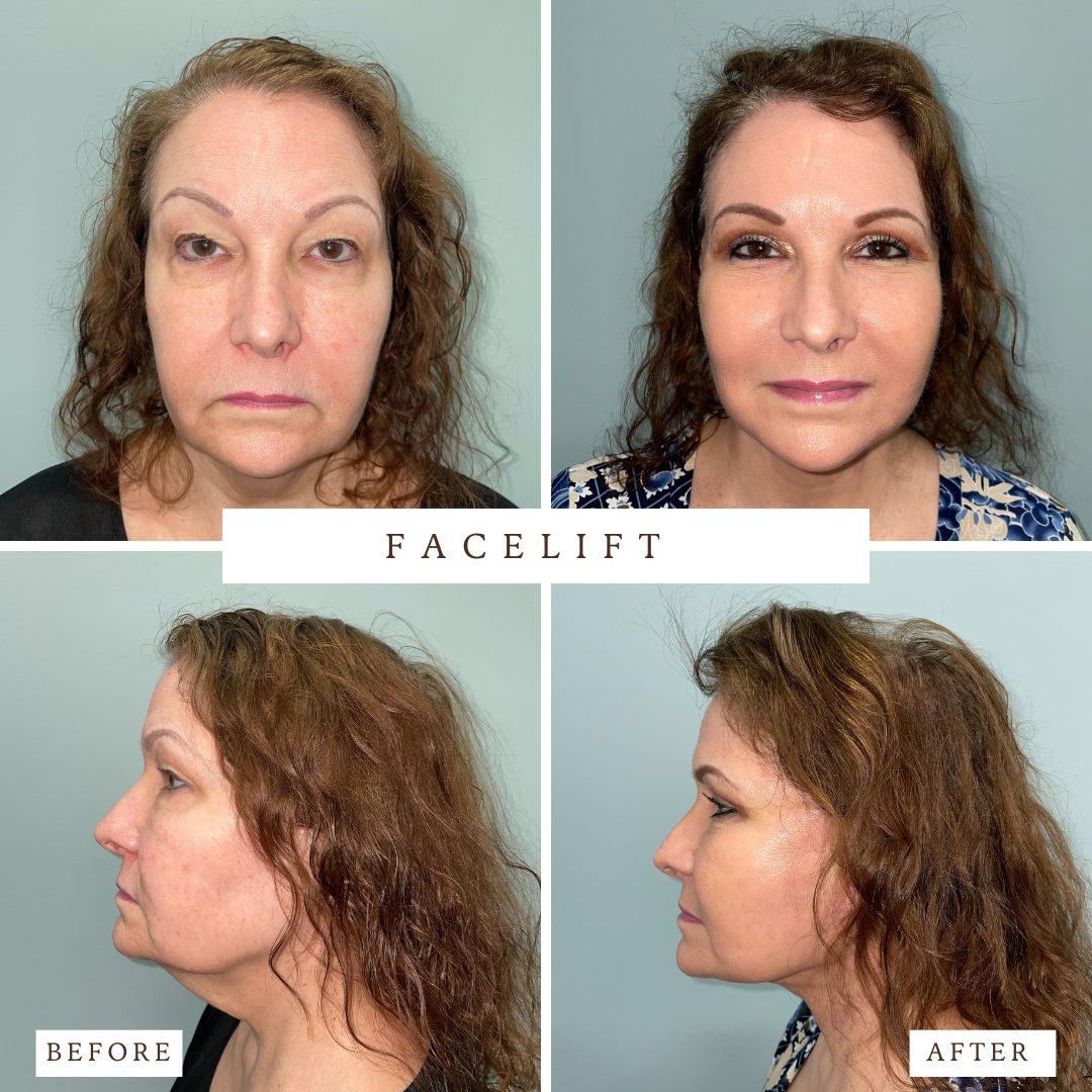 Facelift before and after — actual VedaNu Wellness patient of Dr. James Chao