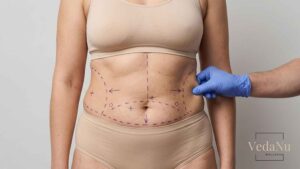 Surgeon assessing waist marked for liposuction.