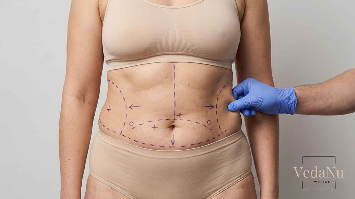 Surgeon assessing waist marked for liposuction.