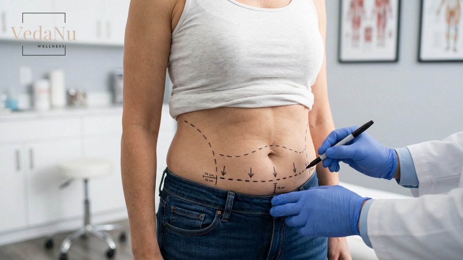 Surgeon marking tummy tuck incision placement on a patient’s lower abdomen.
