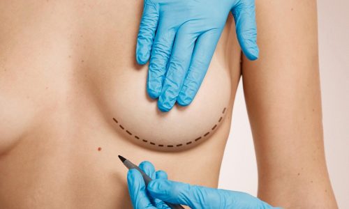 Vedanu wellness | breast procedures