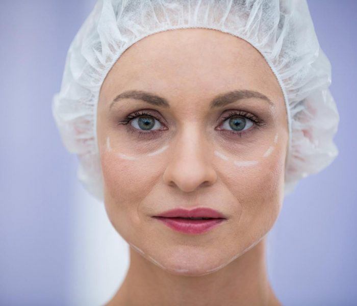Vedanu wellness | blepharoplasty (eyelid surgery)