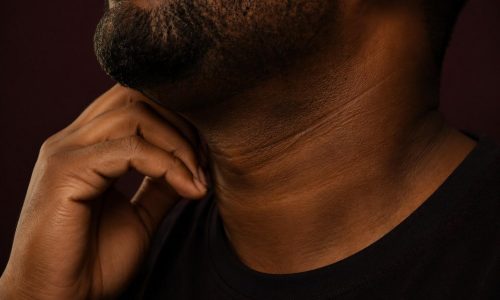 necklift1 Vedanu wellness | neck lift